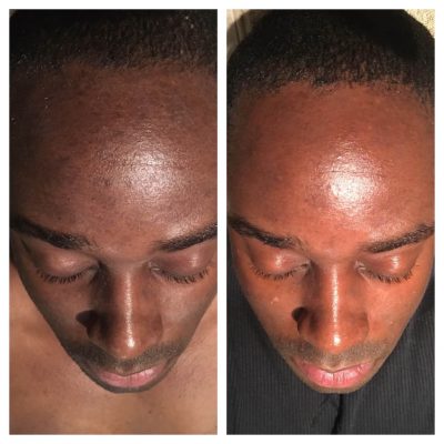 Before and after a chemical peel treatment