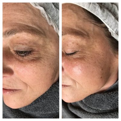 Before and after a Dermplane skin treatment