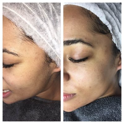 One of our clients before and after Dermaplane Facial