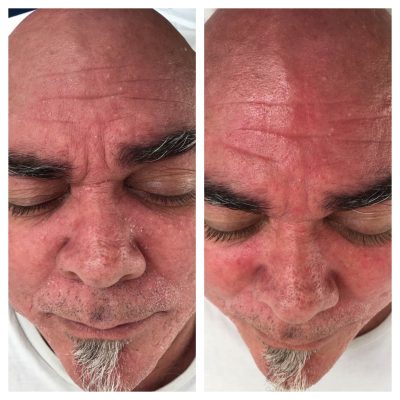 Dermaplane before and after