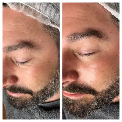 Dermaplane facial treatment male results