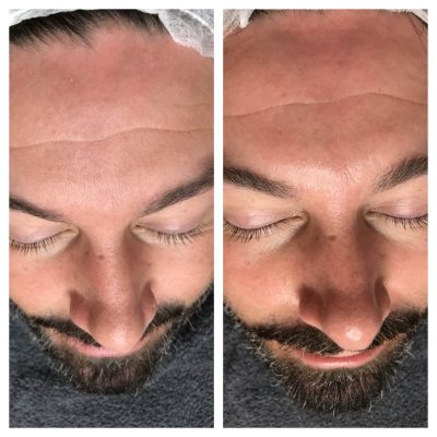 Dermaplane before and after