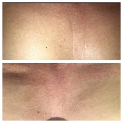 Mesotherapy before and after treatment