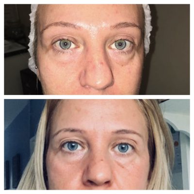 Mesotherapy before and after treatment