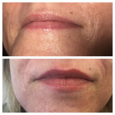Microneedling before and after treatment
