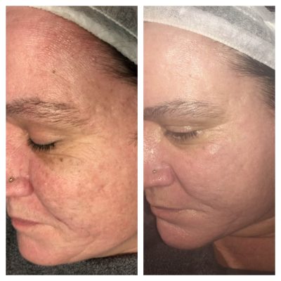 Chemical Peel treatment before and after results