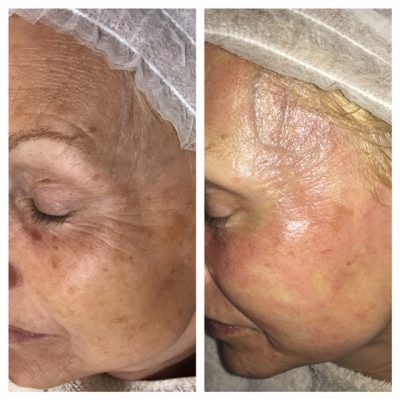 Million Dollar Facial before and after treatment